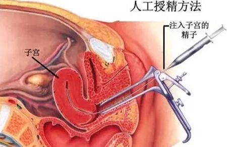 人工授精过程