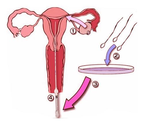 人工授精的过程