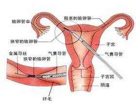 输卵管通液治疗